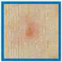 炎症後の紅斑